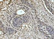 IHC staining of FFPE human liver cancer tissue with EXOSC8 antibody. HIER: boil tissue sections in pH8 EDTA for 20 min and allow to cool before testing.