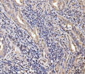 IHC staining of FFPE human gall bladder adenosquamous carcinoma tissue with EXOSC8 antibody. HIER: boil tissue sections in pH8 EDTA for 20 min and allow to cool before testing.