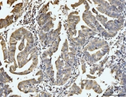 IHC staining of FFPE human gastric adenocarcinoma tissue with EXOSC8 antibody. HIER: boil tissue sections in pH8 EDTA for 20 min and allow to cool before testing.