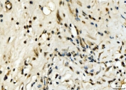 IHC staining of FFPE human renal clear cell carcinoma tissue with EXOSC8 antibody. HIER: boil tissue sections in pH8 EDTA for 20 min and allow to cool before testing.