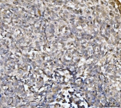 IHC staining of FFPE human lung cancer tissue with EXOSC8 antibody. HIER: boil tissue sections in pH8 EDTA for 20 min and allow to cool before testing.