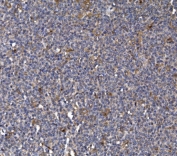 IHC staining of FFPE human lymphoma tissue with FKBP15 antibody. HIER: boil tissue sections in pH8 EDTA for 20 min and allow to cool before testing.