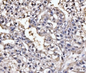 IHC staining of FFPE human liver cancer tissue with GHITM antibody. HIER: boil tissue sections in pH8 EDTA for 20 min and allow to cool before testing.