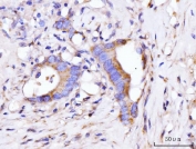 IHC staining of FFPE human colorectal cancer tissue with GIGYF2 antibody. HIER: boil tissue sections in pH8 EDTA for 20 min and allow to cool before testing.