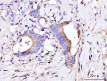 IHC staining of FFPE human colorectal cancer tissue with GIGYF2 antibody. HIER: boil tissue sections in pH8 EDTA for 20 min and allow to cool before testing.
