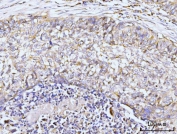 IHC staining of FFPE human lung cancer tissue with GIT1 antibody. HIER: boil tissue sections in pH8 EDTA for 20 min and allow to cool before testing.
