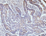 IHC staining of FFPE human gastric adenocarcinoma tissue with GIT1 antibody. HIER: boil tissue sections in pH8 EDTA for 20 min and allow to cool before testing.