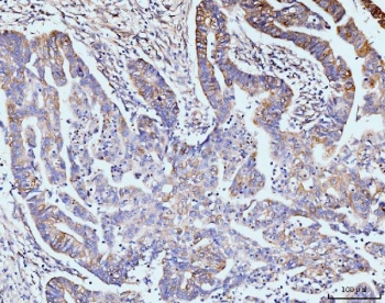 IHC staining of FFPE human gastric adenocarcinoma tissue with GIT1 antibody. HIER: boil tissue sections in pH8 EDTA for 20 min and allow to cool before testing.