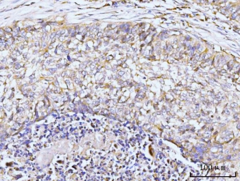IHC staining of FFPE human lung cancer tissue with GIT1 antibody. HIER: boil tissue sections in pH8 EDTA for 20 min and allow to cool before testing.