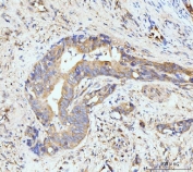 IHC staining of FFPE human gall bladder adenosquamous carcinoma tissue with GIT1 antibody. HIER: boil tissue sections in pH8 EDTA for 20 min and allow to cool before testing.