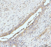 IHC staining of FFPE human appendiceal adenocarcinoma tissue with GIT1 antibody. HIER: boil tissue sections in pH8 EDTA for 20 min and allow to cool before testing.