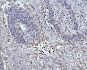 IHC staining of FFPE human liver cancer tissue with GLUL antibody. HIER: boil tissue sections in pH8 EDTA for 20 min and allow to cool before testing.
