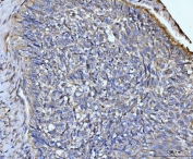 IHC staining of FFPE human lung cancer tissue with GLUL antibody. HIER: boil tissue sections in pH8 EDTA for 20 min and allow to cool before testing.