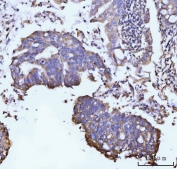 IHC staining of FFPE human gastric adenocarcinoma tissue with GLUL antibody. HIER: boil tissue sections in pH8 EDTA for 20 min and allow to cool before testing.
