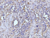 IHC staining of FFPE human appendiceal adenocarcinoma tissue with GLUL antibody. HIER: boil tissue sections in pH8 EDTA for 20 min and allow to cool before testing.