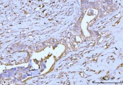 IHC staining of FFPE human appendiceal adenocarcinoma tissue with GNB3 antibody. HIER: boil tissue sections in pH8 EDTA for 20 min and allow to cool before testing.