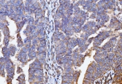 IHC staining of FFPE human bladder epithelial carcinoma tissue with GNB3 antibody. HIER: boil tissue sections in pH8 EDTA for 20 min and allow to cool before testing.