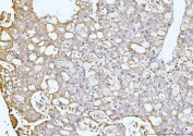 IHC staining of FFPE human liver cancer tissue with GNB3 antibody. HIER: boil tissue sections in pH8 EDTA for 20 min and allow to cool before testing.