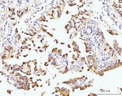 IHC staining of FFPE human colonic adenocarcinoma tissue with Nucleostemin antibody. HIER: boil tissue sections in pH8 EDTA for 20 min and allow to cool before testing.