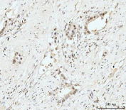 IHC staining of FFPE human appendiceal adenocarcinoma tissue with Nucleostemin antibody. HIER: boil tissue sections in pH8 EDTA for 20 min and allow to cool before testing.