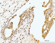 IHC staining of FFPE human breast cancer tissue with Nucleostemin antibody. HIER: boil tissue sections in pH8 EDTA for 20 min and allow to cool before testing.