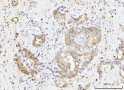 IHC staining of FFPE human gall bladder adenosquamous carcinoma tissue with Nucleostemin antibody. HIER: boil tissue sections in pH8 EDTA for 20 min and allow to cool before testing.