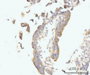 IHC staining of FFPE human colonic adenocarcinoma tissue with Golgin 97 antibody. HIER: boil tissue sections in pH8 EDTA for 20 min and allow to cool before testing.