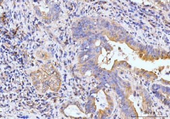 IHC staining of FFPE human gall bladder adenosquamous carcinoma tissue with Golgin 97 antibody. HIER: boil tissue sections in pH8 EDTA for 20 min and allow to cool before testing.