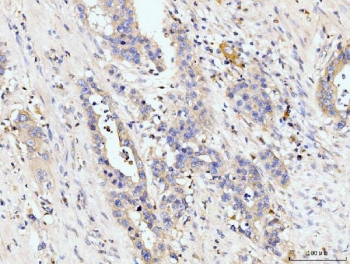 IHC staining of FFPE human appendiceal adenocarcinoma tissue with Golgin 97 antibody. HIER: boil tissue sections in pH8 EDTA for 20 min and allow to cool before testing.