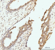 IHC staining of FFPE human breast cancer tissue with Golgin 97 antibody. HIER: boil tissue sections in pH8 EDTA for 20 min and allow to cool before testing.