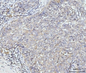 IHC staining of FFPE human lung cancer tissue with Golgin 97 antibody. HIER: boil tissue sections in pH8 EDTA for 20 min and allow to cool before testing.