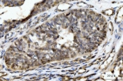 IHC staining of FFPE human bladder epithelial carcinoma tissue with HES5 antibody. HIER: boil tissue sections in pH8 EDTA for 20 min and allow to cool before testing.