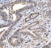 IHC staining of FFPE human gall bladder adenosquamous carcinoma tissue with HES5 antibody. HIER: boil tissue sections in pH8 EDTA for 20 min and allow to cool before testing.