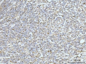 IHC staining of FFPE human lymphadenoma tissue with GRPEL1 antibody. HIER: boil tissue sections in pH8 EDTA for 20 min and allow to cool before testing.