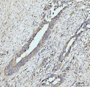 IHC staining of FFPE human appendiceal adenocarcinoma tissue with GRPEL1 antibody. HIER: boil tissue sections in pH8 EDTA for 20 min and allow to cool before testing.