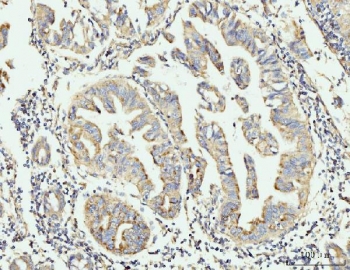 IHC staining of FFPE human gastric adenocarcinoma tissue with GRPEL1 antibody. HIER: boil tissue sections in pH8 EDTA for 20 min and allow to cool before testing.