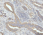 IHC staining of FFPE human gall bladder adenosquamous carcinoma tissue with GRPEL1 antibody. HIER: boil tissue sections in pH8 EDTA for 20 min and allow to cool before testing.