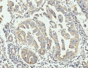 IHC staining of FFPE human gastric adenocarcinoma tissue with GRPEL1 antibody. HIER: boil tissue sections in pH8 EDTA for 20 min and allow to cool before testing.