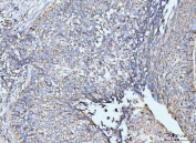IHC staining of FFPE human lung cancer tissue with GRPEL1 antibody. HIER: boil tissue sections in pH8 EDTA for 20 min and allow to cool before testing.