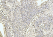 IHC staining of FFPE human liver cancer tissue with GRPEL1 antibody. HIER: boil tissue sections in pH8 EDTA for 20 min and allow to cool before testing.