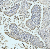 IHC staining of FFPE human esophageal squamous carcinoma tissue with GRPEL1 antibody. HIER: boil tissue sections in pH8 EDTA for 20 min and allow to cool before testing.