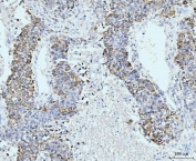 IHC staining of FFPE human liver cancer tissue with GSPT1/2 antibody. HIER: boil tissue sections in pH8 EDTA for 20 min and allow to cool before testing.