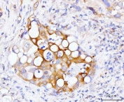 IHC staining of FFPE human gall bladder adenosquamous carcinoma tissue with GSPT1/2 antibody. HIER: boil tissue sections in pH8 EDTA for 20 min and allow to cool before testing.