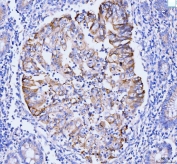 IHC staining of FFPE human gastric adenocarcinoma tissue with GSPT1/2 antibody. HIER: boil tissue sections in pH8 EDTA for 20 min and allow to cool before testing.