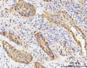 IHC staining of FFPE human gall bladder adenosquamous carcinoma tissue with HMGCS1 antibody. HIER: boil tissue sections in pH8 EDTA for 20 min and allow to cool before testing.