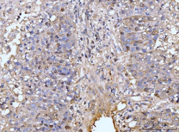 IHC staining of FFPE human liver cancer tissue with HMGCS1 antibody. HIER: boil tissue sections in pH8 EDTA for 20 min and allow to cool before testing.