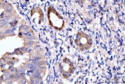 IHC staining of FFPE human gastric adenocarcinoma tissue with HMGCS1 antibody. HIER: boil tissue sections in pH8 EDTA for 20 min and allow to cool before testing.