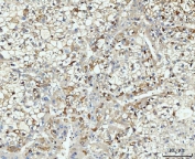 IHC staining of FFPE human liver cancer tissue with HMGCS1 antibody. HIER: boil tissue sections in pH8 EDTA for 20 min and allow to cool before testing.