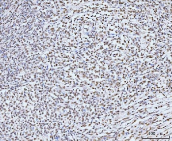 IHC staining of FFPE human lymphadenoma tissue with KIFC1 antibody. HIER: boil tissue sections in pH8 EDTA for 20 min and allow to cool before testing.