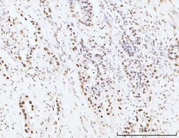 IHC staining of FFPE human appendiceal adenocarcinoma tissue with KIFC1 antibody. HIER: boil tissue sections in pH8 EDTA for 20 min and allow to cool before testing.
